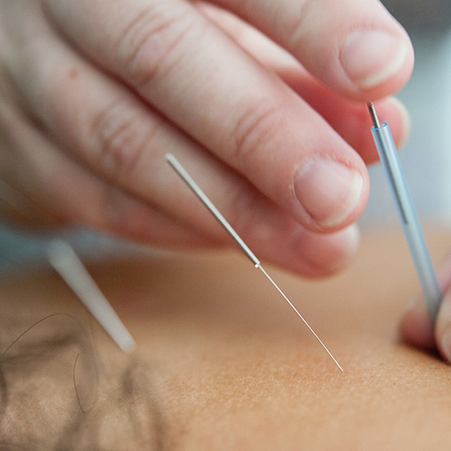 Acupuncture Calgary  - Optimum Wellness Centres