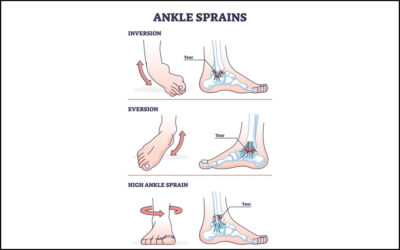 Inversion Ankle Sprain