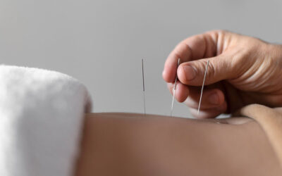 What is Acupuncture?