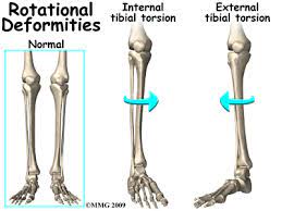 External Tibial Torsion