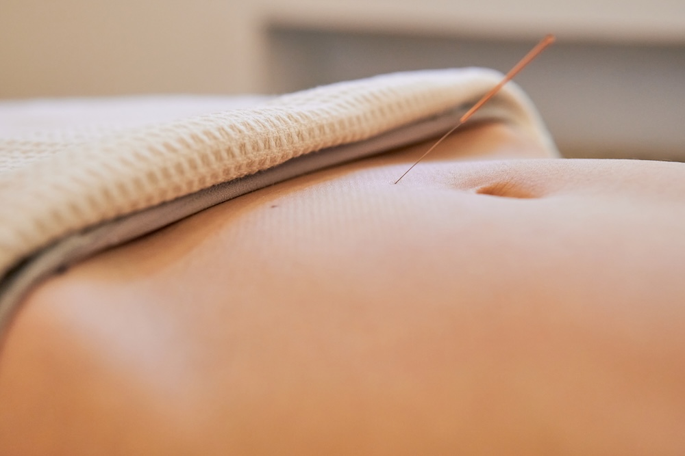 Fertility Acupuncture Fertility Acupuncture